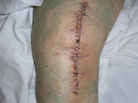 Closed Surgical Wounds