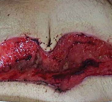 Open Surgical Wounds