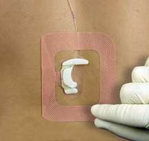 EPI-FIX Dispositivo de fijación para catéter epidural