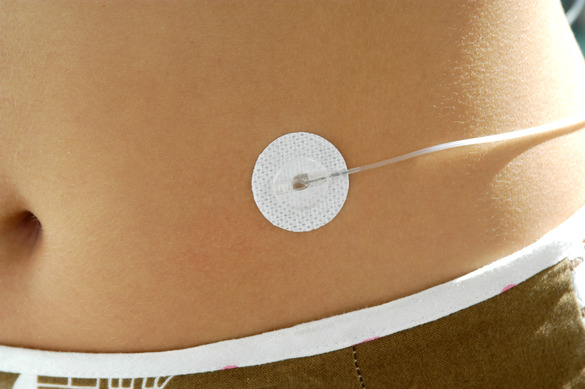 neria™ – Simplifying subcutaneous infusion