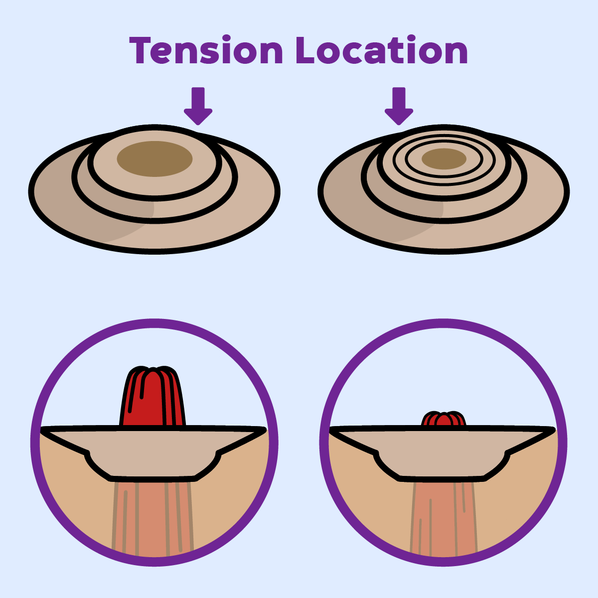 Animated GIF illustrating convexity tension on peristomal topography, exerted by the convex dome.