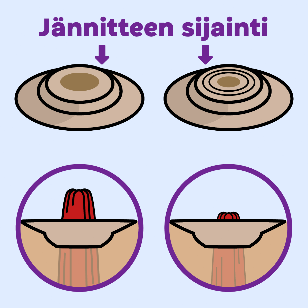 Animated GIF illustrating convexity tension on peristomal topography, exerted by the convex dome.
