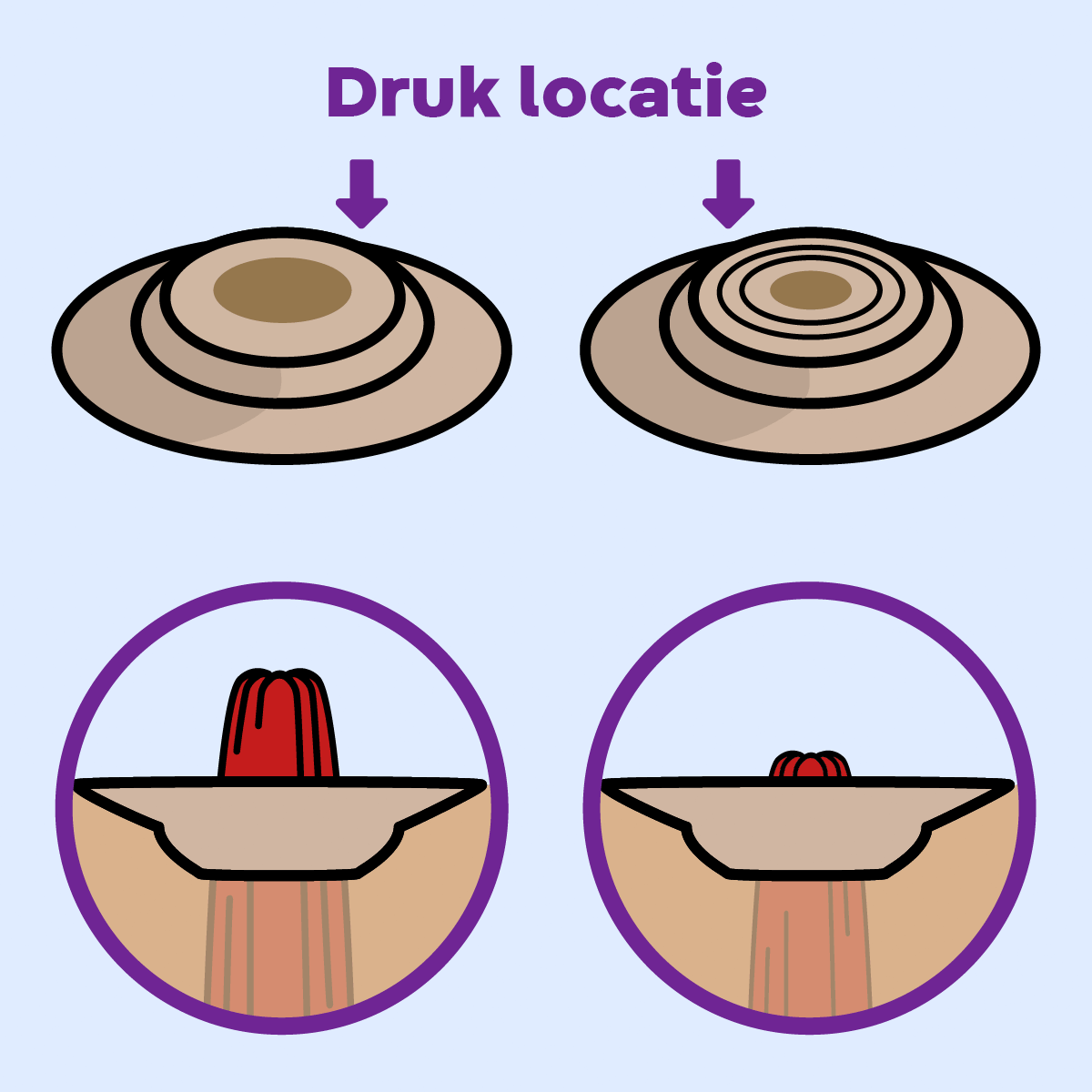 Animated GIF illustrating convexity tension on peristomal topography, exerted by the convex dome.