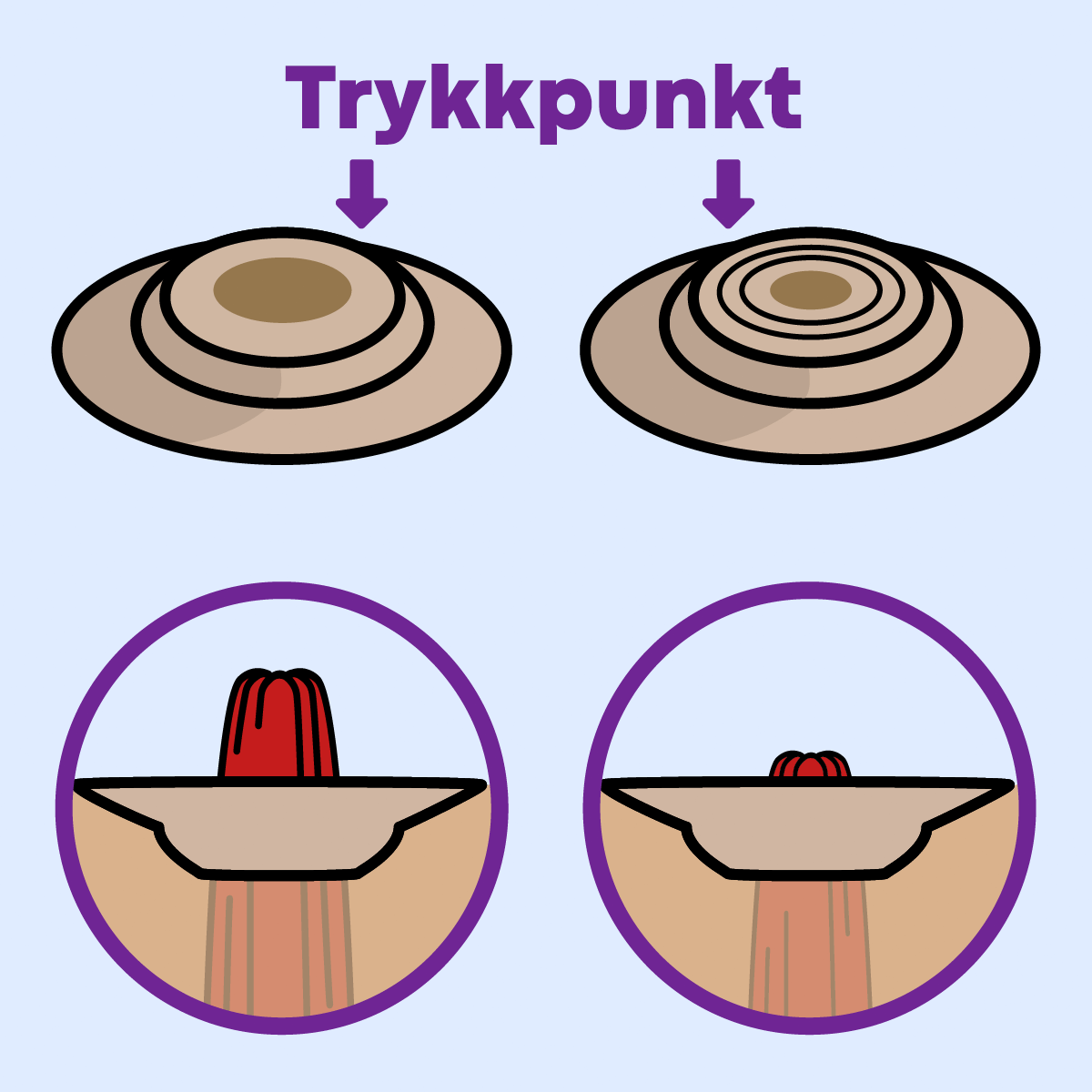 Animated GIF illustrating convexity tension on peristomal topography, exerted by the convex dome.