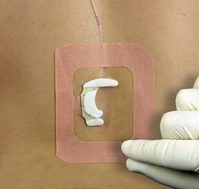 Epi-Fix™ securement device - Continence & Critical Care | ConvaTec